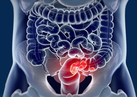 Lei que cria o ‘Março Azul Marinho’, de atenção ao câncer de intestino, é sancionada no Amazonas