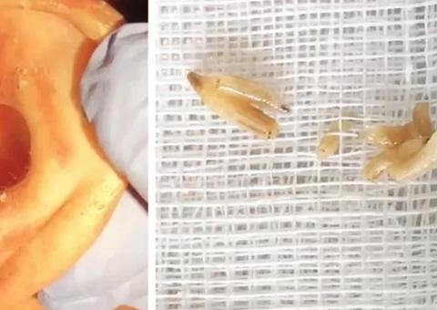 Médicos encontram infestação de larvas carnívoras no ouvido de homem