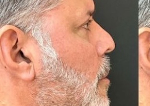 Alexandre Frota faz harmonização facial e mostra resultado