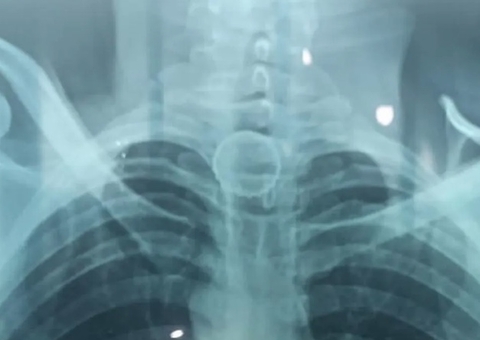 Homem engole tampa de cerveja ao abrir garrafa no Ano Novo no Amazonas