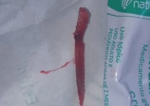 Menina é perfurada por ferrão de peixe venenoso enquanto nadava em rio