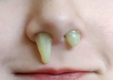 Saiba o que indica a cor do catarro sobre a saúde; verde e amarelo são os mais comuns