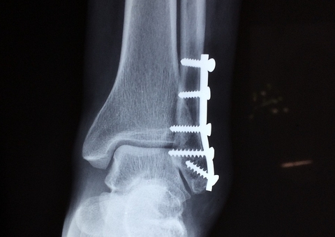 Osteoporose atinge 1 a cada 3 mulheres e tratamento precoce evita fraturas