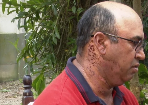 Veja como ficou boné de homem atingido por raio na cabeça