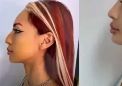 Ruivinha de Marte faz harmonização facial com rinomodelação e mostra antes e depois; foto