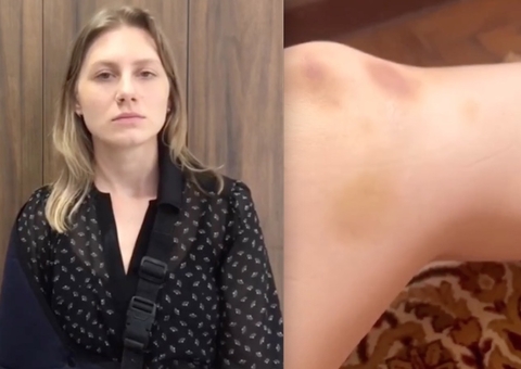 Comediante Lea Maria mostra hematomas e diz que ex tentou influenciar sua psicóloga