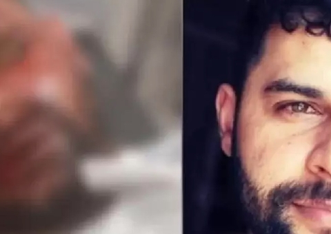 Tatuador fica cego após ex-namorada jogar soda cáustica em seu rosto