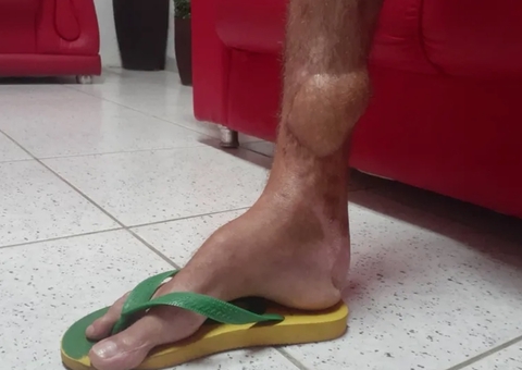 Homem é indenizado em R$ 15 mil por ficar 2 anos com caco de vidro enfiado na perna por erro médico