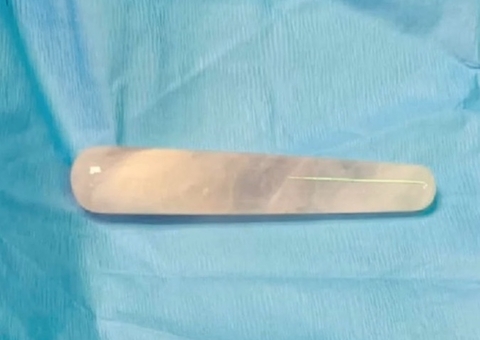 Mulher passa por cirurgia para retirar vibrador após ir parar em local errado