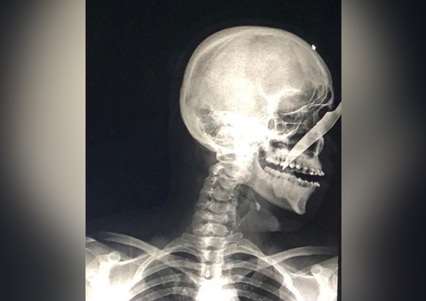 Bêbado, homem crava faca no rosto de jovem em rua no Amazonas