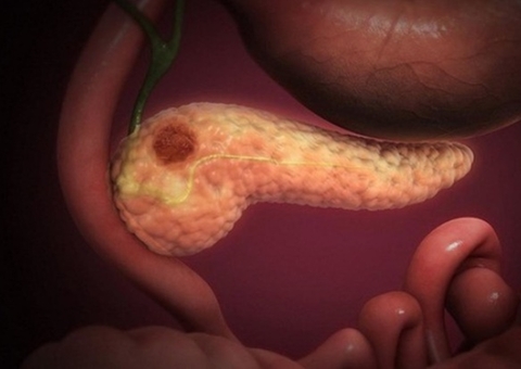 Câncer de pâncreas vem sendo detectado em jovens e principalmente mulheres, diz oncologista