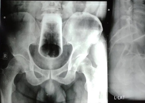 Homem enfia copo de vidro de 12 cm no ânus durante bebedeira