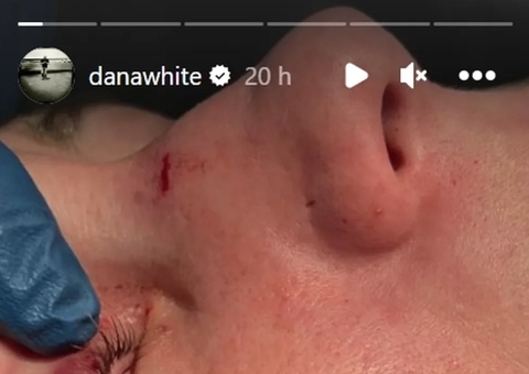 Dana White mostra corte no rosto de Karol Rosa após UFC