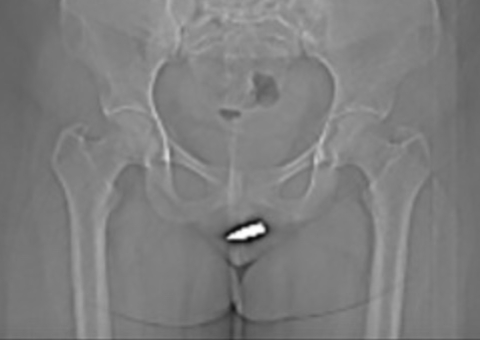 Mulher fica com bala alojada no clitóris após tiro acidental em casa