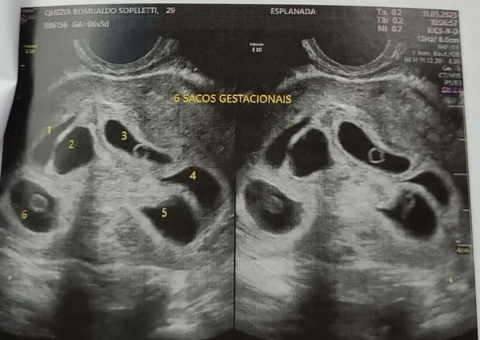 Mãe descobre estar grávida de sêxtuplos durante ultrassom para ver um bebê; pai passou mal