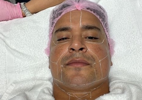 Xanddy mostra marcas para fazer procedimento no rosto: 'cara do Henry Cavill'