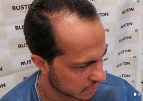 Thammy Miranda mostra resultado de transplante capilar: 'cabeludo de novo'