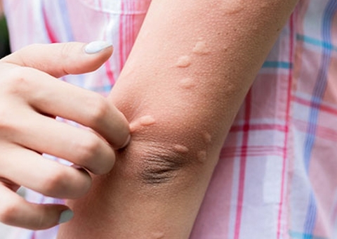 Conheça as alergias mais comuns e seus sintomas