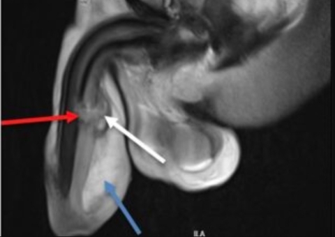 Homem quebra o pênis em 3 partes após 'sentada mortal' da namorada
