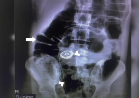 Homem passa por cirurgia após desodorante ‘sumir’ em ânus durante masturbação