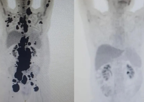 Homem com câncer há 13 anos tem remissão completa em um mês após terapia celular