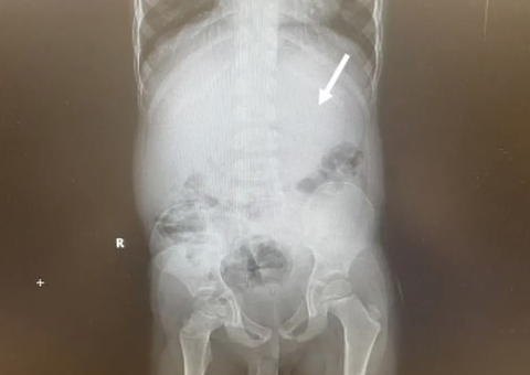 Criança engole 40 chicletes e passa por cirurgia para desobstruir estômago