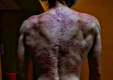 Jovem fica com o corpo cheio de espinhas após tomar anabolizante