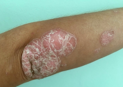 Amazonas vai reforçar ações contra doenças de pele em 12 municípios