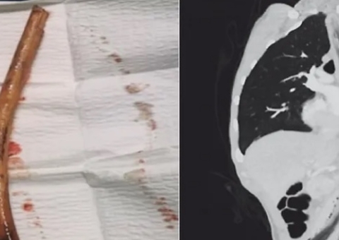 Homem engole pedaço de madeira de 30cm após ter sido ordenado por 'vozes'