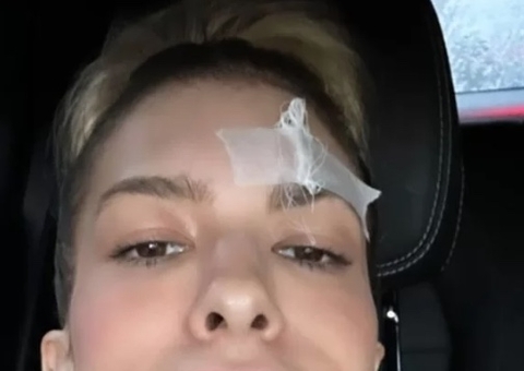 Lore Improta sofre acidente doméstico e leva pontos no rosto