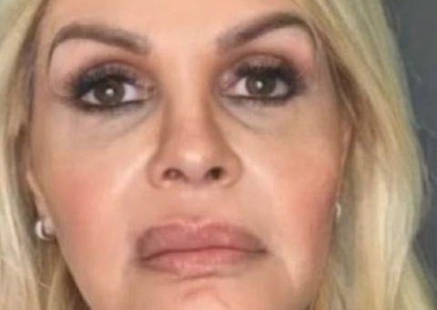 Monique Evans mostra resultado de harmonização facial 