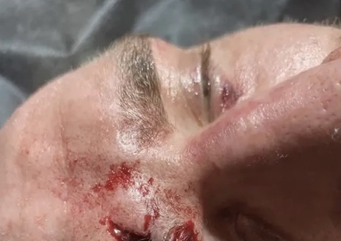 Imagem forte: Lutador sérvio sofre corte profundo na testa no KSW 84