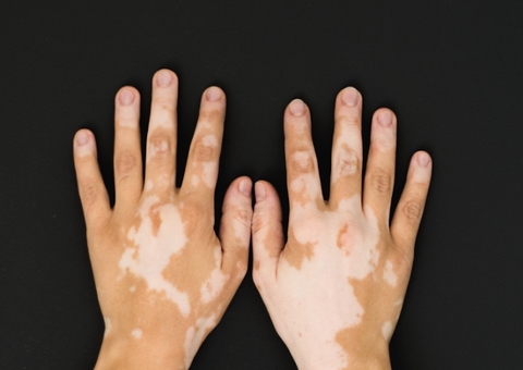 Amazonas emite alerta para alto número de casos de vitiligo no estado 
