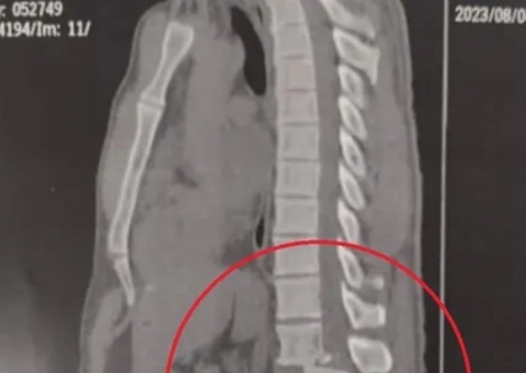 Veja raio x que mostra lesão grave na coluna de aluno atingido por aparelho de academia