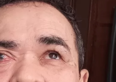 Idoso com tumor gigante no rosto entra na Justiça para conseguir cirurgia