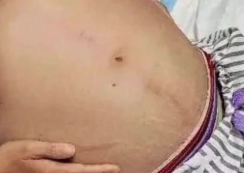 Mulher passa por cirurgia para retirar cocô gigante de 1 metro e 20kg