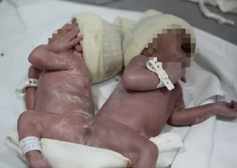 Gêmeos siameses nascem unidos pela coluna; caso é considerado raro