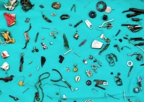 Médicos retiram 60 objetos de estômago de paciente