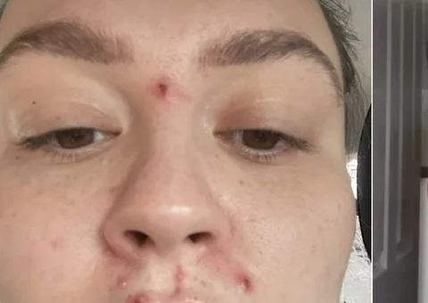 Mulher relata sobre doença após 'pelo inflamado na axila': "carne podre caía do meu corpo"