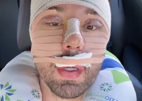 Rico Melquiades faz nova plástica e desabafa: 'não aguentava mais vocês me chamarem de feio'