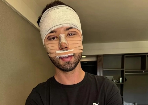 Rico Melquíades mostra antes e depois de cirurgias no rosto