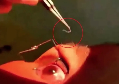 Após crise de coceira, mulher descobre 60 vermes vivos nos olhos