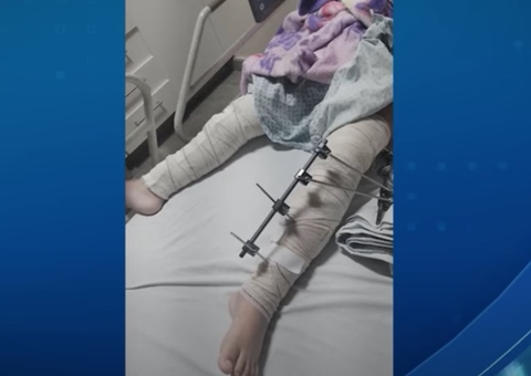 Médicos se confundem e menina de 6 anos tem pinos colocados em perna errada