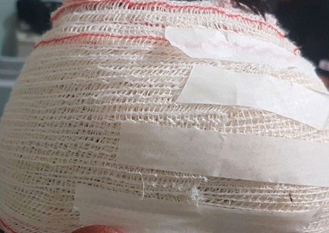 DPU pede seguro a vítimas de escalpelamento, acidente comum na região amazônica