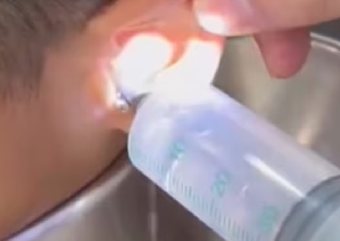 Médico retira inseto e pedaços de frutas de ouvido de criança; veja vídeo