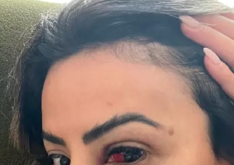 Influencer brasileira fratura órbita ocular, nariz e maxilar ao ser espancada pelo namorado em Paris