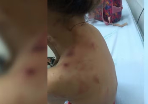 Pit bulls pulam cerca e atacam três crianças