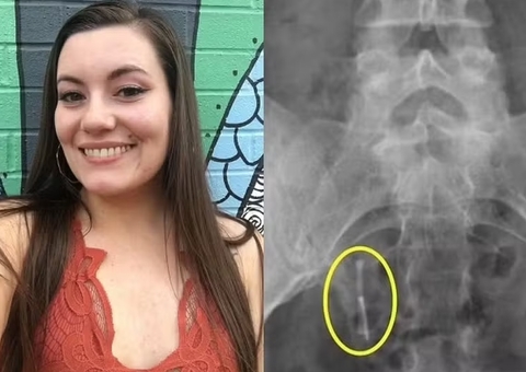 Mulher encontra DIU no reto 12 anos após acidente