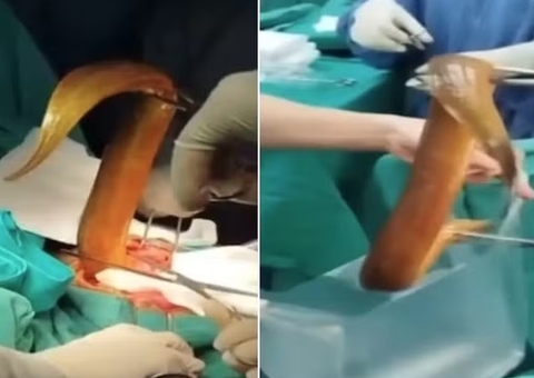 Homem passa por cirurgia após enfiar enguia de 60cm e limão no ânus para prazer