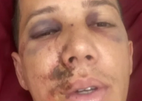 Árbitro sofre fraturas após ser agredido: “Poderia estar em cadeira de rodas”